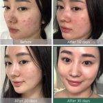 کیت ضدآکنه فوری لاین معجزه ۳۰ روزه سام بای می - Image 5